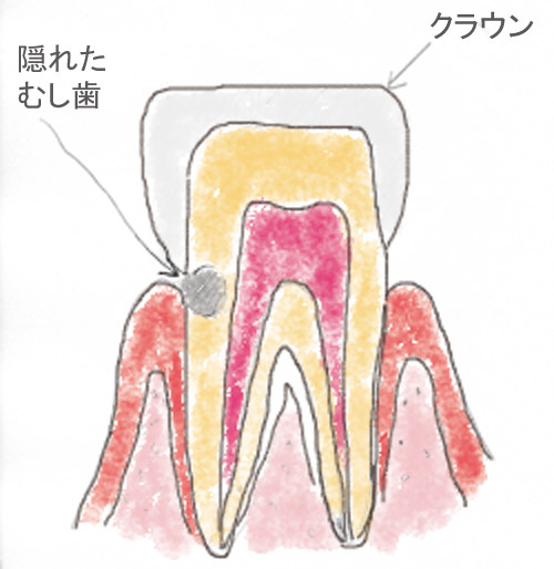 治療した歯の注意点